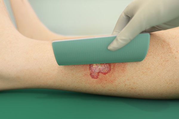 An illustration of Sorbact foam dressing over a wound.