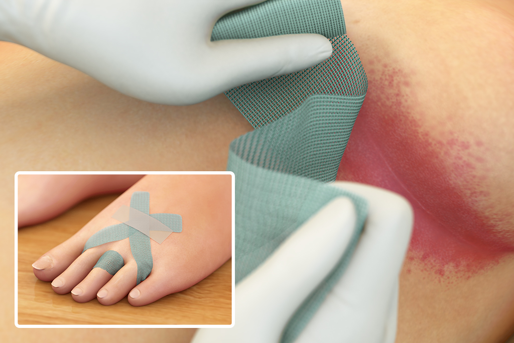 Apply sorbact ribbon gauze to illustrated wounds