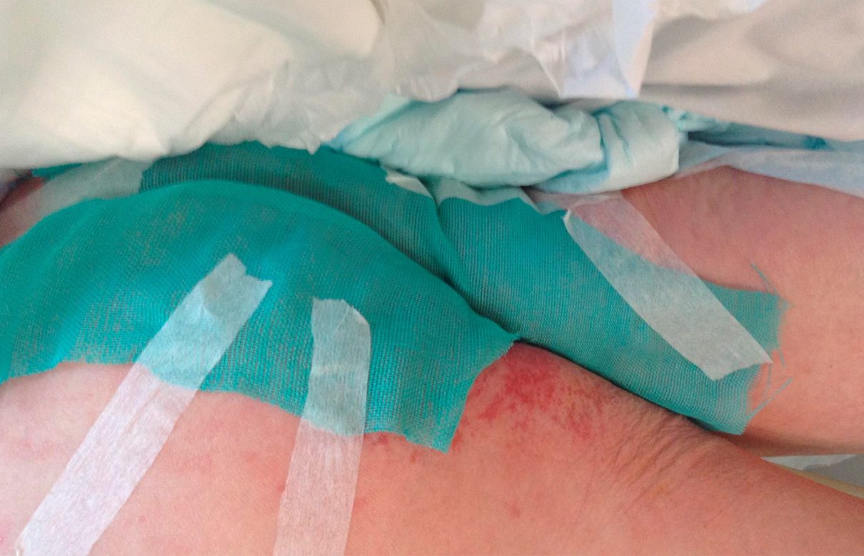 Sorbact dressing applied to skin with visible skin irritation.