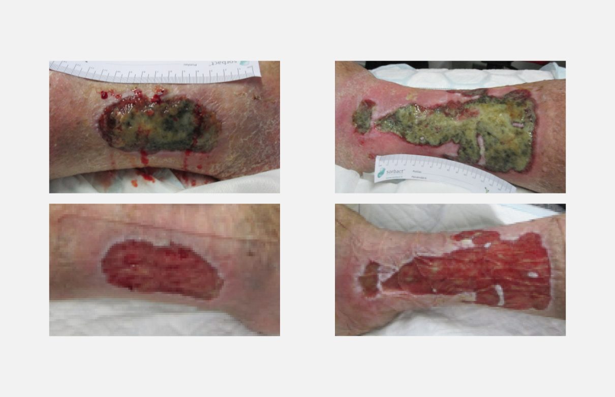 Before and after images of hard-to-heal leg ulcers on a patient’s left and right leg. The wounds show clear improvement three weeks after treatment with Sorbact.