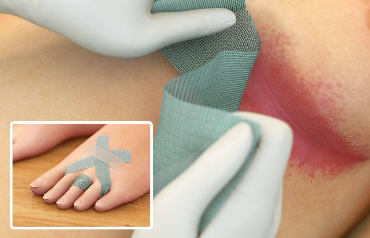 Illustration of a green Sorbact dressing being placed in a red skin fold. Inset shows dressing applied between toes.